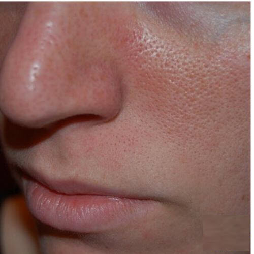 Cải thiện và ngăn ngừa da mặt sần vỏ cam