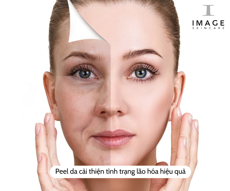 sản phẩm peel da trị mụn