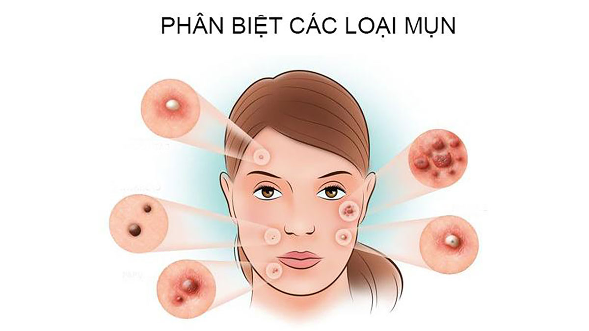 Các loại mụn cơ bản